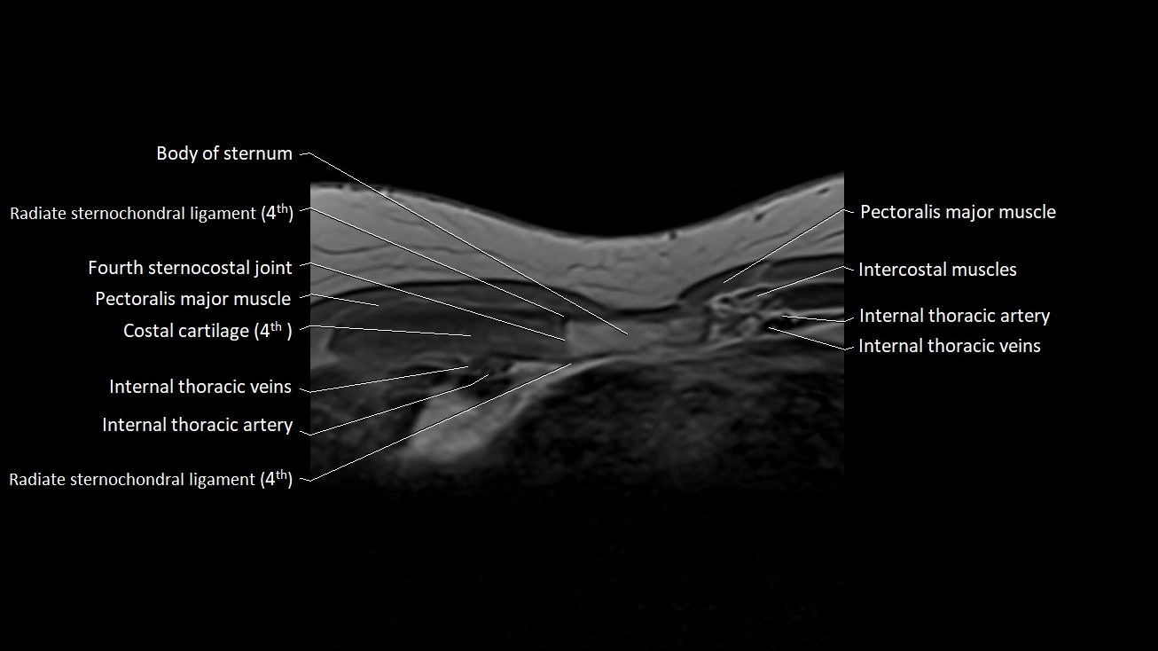 MRI sternum and sternoclavicular joint labeled axial anatomy image 25.webp